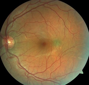 choroidal nevus