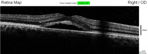 70025V_LANDIN_JOSE__3688_Retina Map FullTh_OD_2013-08-02_09-45-43_M_1971-02-07_Main Report