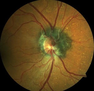 melanocytoma