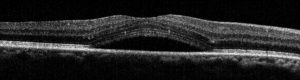 csr_10835_Retina Map FullSig_OD_2016-05-07_11-43-55_F_1964-03-31_Main Report